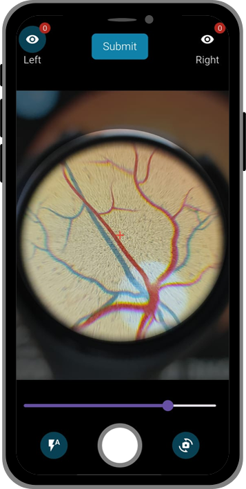 Lunera app screen showing a retinal image